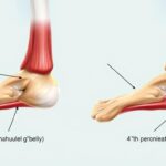 Mięsień strzałkowy czwarty