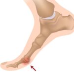 Trzeszczka dwudzielna