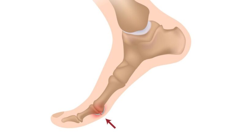 Trzeszczka dwudzielna