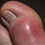 Ból dużego palca w stopie a cukrzyca – kiedy warto się zaniepokoić? ból dużego palca w stopie a cukrzyca