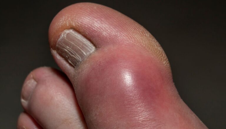 ból dużego palca w stopie a cukrzyca