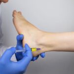 Przykurcz ścięgna Achillesa objawy – jak go rozpoznać i leczyć? Przykurcz ścięgna Achillesa objawy