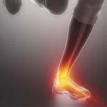 Ścięgno Achillesa ból przy chodzeniu – jak złagodzić i leczyć? Ścięgno Achillesa ból przy chodzeniu