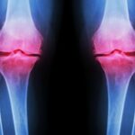 Przeciążenie kolana ile trwa i jak przyspieszyć regenerację