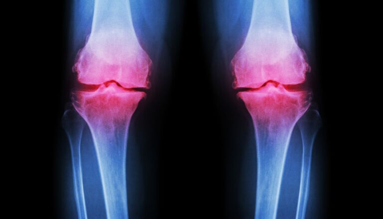 Przeciążenie kolana ile trwa i jak przyspieszyć regenerację