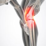 ACL kolana – rola więzadła i urazy ACL kolana