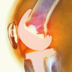 Objawy odrzucenia endoprotezy kolana – na co zwrócić uwagę Objawy odrzucenia endoprotezy kolana