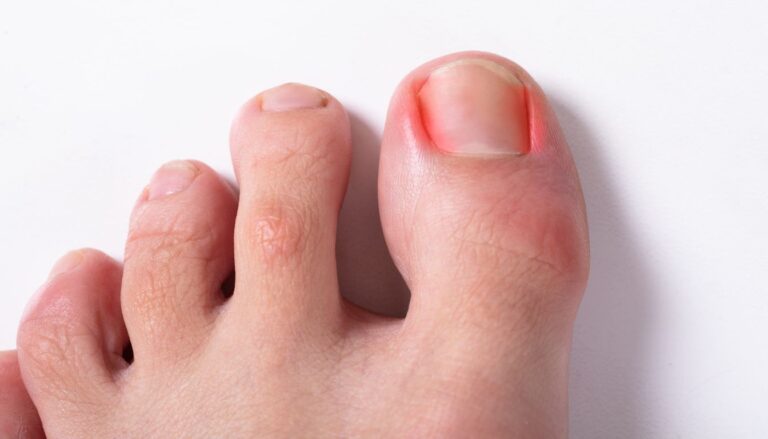ból dużego palca w stopie przy paznokciu