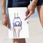 Czego nie wolno robić po wstrzyknięciu kwasu hialuronowego w kolano – zalecenia i przeciwwskazania Czego nie wolno robić po wstrzyknięciu kwasu hialuronowego w kolano