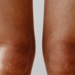 Jak wyprostować szpotawe kolana u dorosłych – poradnik Jak wyprostować szpotawe kolana u dorosłych