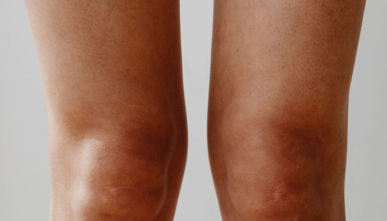 Jak wyprostować szpotawe kolana u dorosłych