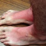 Piekący ból stóp – co oznacza i jak sobie z nim poradzić? Piekący ból stóp