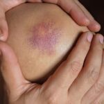 Zapalenie kolana objawy i jak je skutecznie leczyć Zapalenie kolana objawy i jak je skutecznie leczyć