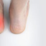 Zapalenie ścięgna Achillesa