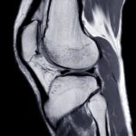 Rezonans kolana jak się przygotować do badania Rezonans kolana jak się przygotować do badania