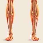 Krzywe kolana – przyczyny i korekta krzywe kolana