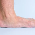Płaskostopie podłużne – co to jest i jak je leczyć Płaskostopie podłużne