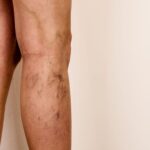 Żylaki na łydkach – przyczyny, objawy i sposoby leczenia Żylaki na łydkach