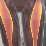 Mięsień dwugłowy uda przyczepy – szczegóły anatomiczne Mięsień dwugłowy uda przyczepy