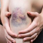 Samoistne siniaki na łydkach – przyczyny i kiedy udać się do lekarza Samoistne siniaki na łydkach