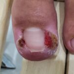 Wrastające paznokcie u nóg – jak im skutecznie zapobiegać? Wrastające paznokcie u nóg