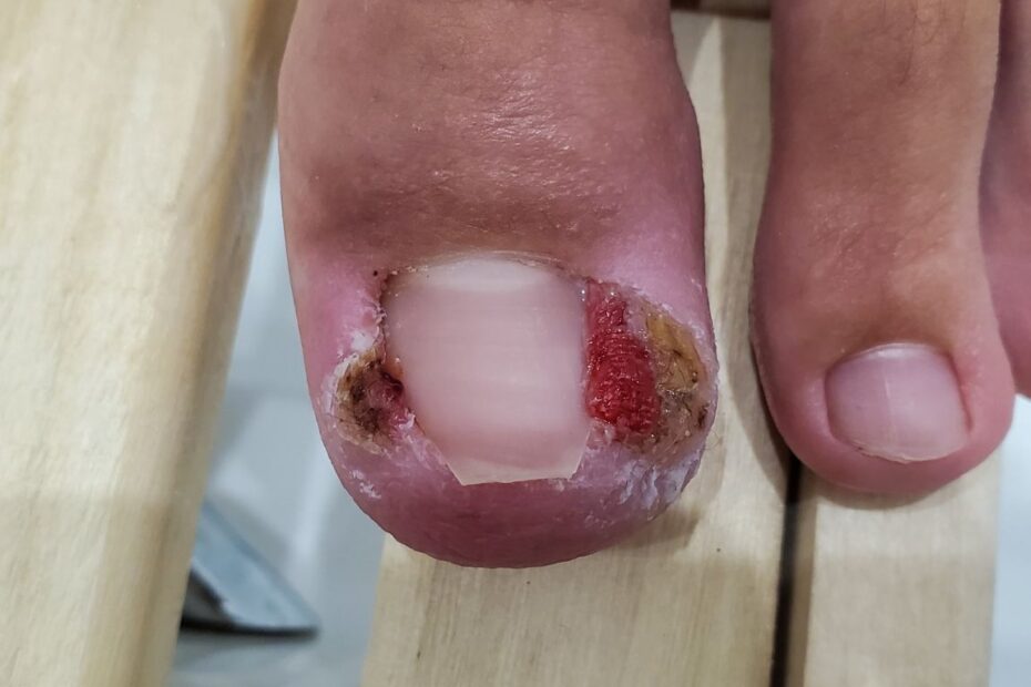 Wrastające paznokcie u nóg