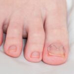 Wrastający paznokieć u nóg – objawy, leczenie i zapobieganie Wrastający paznokieć u nóg