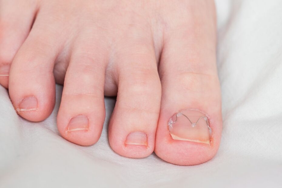 Wrastający paznokieć u nóg