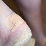 Bolący odcisk na stopie