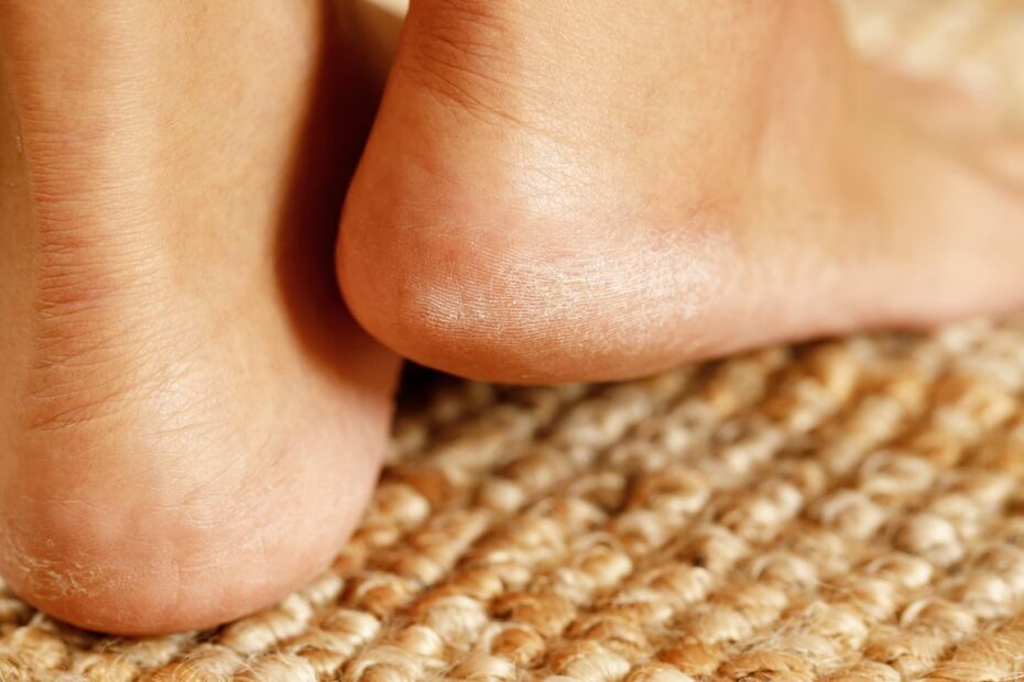 Bolący odcisk na pięcie