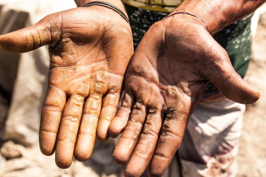 Twarde odciski na dłoniach