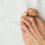 Czy grzybica paznokci boli? – objawy i odczucia towarzyszące Czy grzybica paznokci boli?