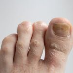 Grzybica paznokci u dzieci