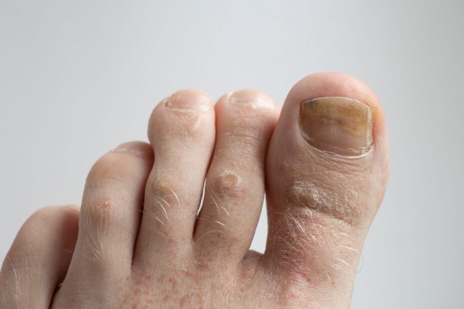 Grzybica paznokci u dzieci