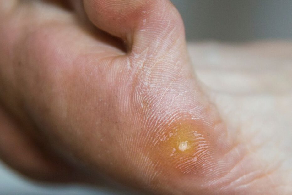 Jak rozpoznać kurzajkę