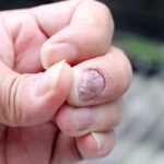 Domowe sposoby na grzybicę paznokci – naturalne metody leczenia Domowe sposoby na grzybicę paznokci