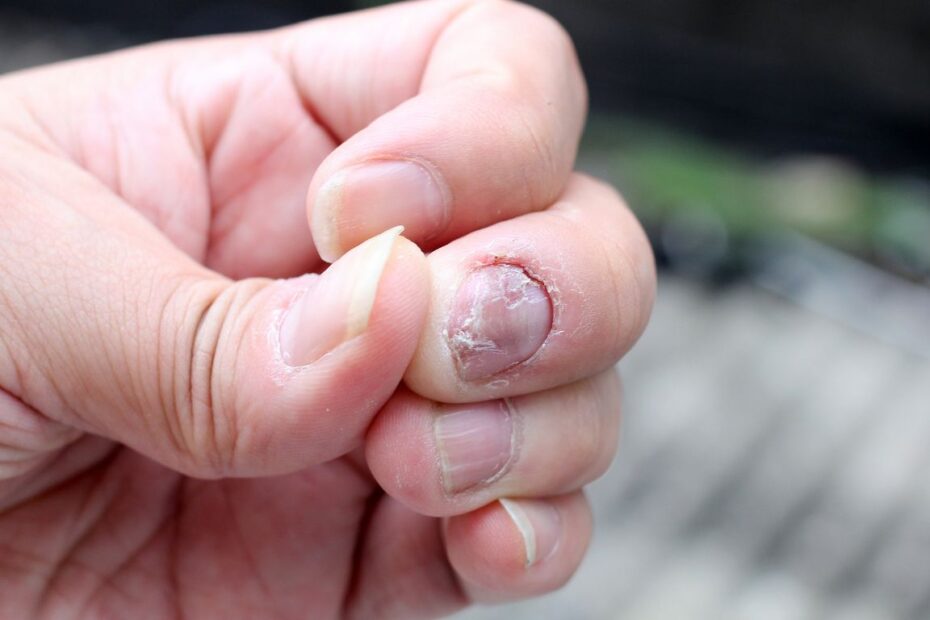 Domowe sposoby na grzybicę paznokci