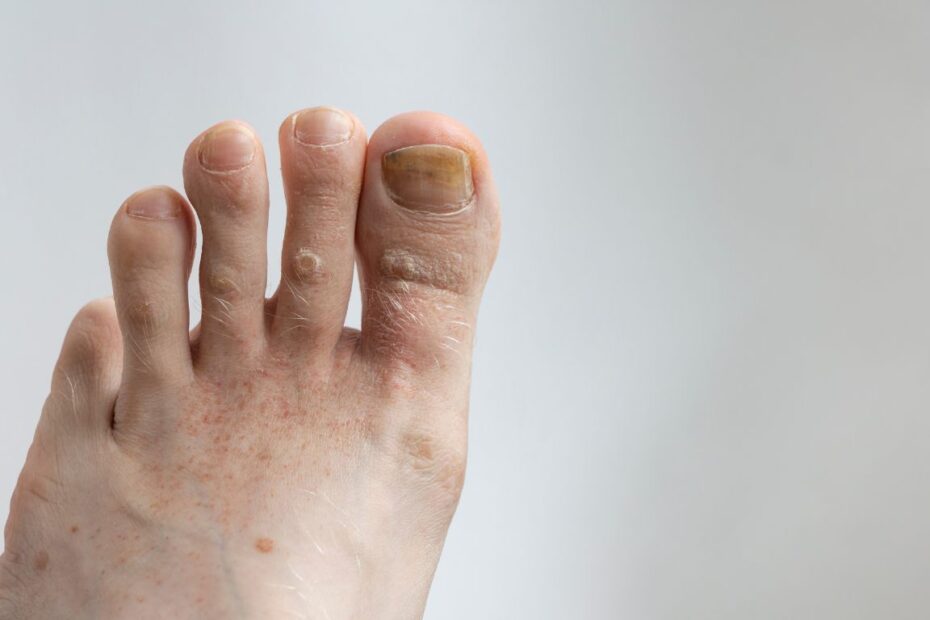 Octenisept na grzybicę paznokci