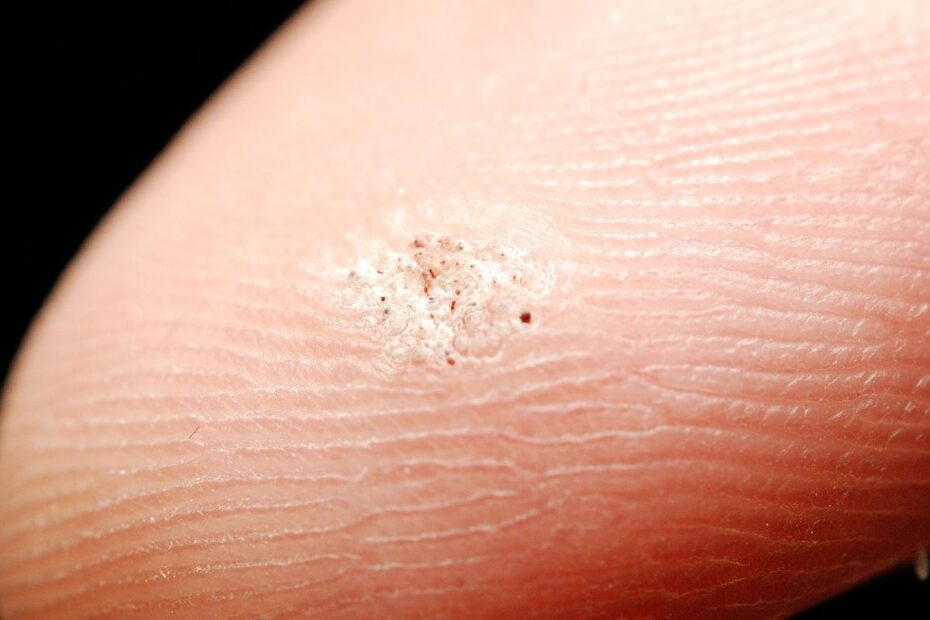 Help 4 skin kurzajki