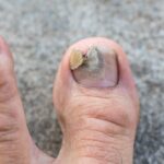 Amol na grzybicę paznokci – naturalny sposób na walkę z infekcją Amol na grzybicę paznokci