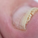 Jak stosować domestos na grzybicę paznokci