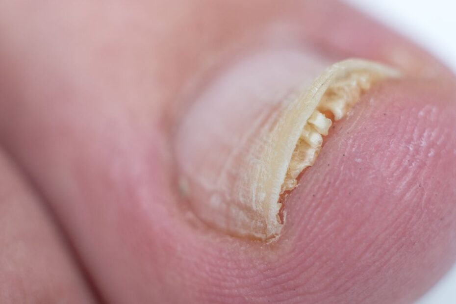 Jak stosować domestos na grzybicę paznokci