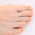 Co powoduje nieleczona grzybica paznokci – zagrożenia i powikłania Co powoduje nieleczona grzybica paznokci