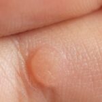 Jak pozbyć się kurzajek skutecznie i bezpiecznie?