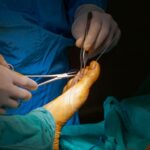 4 miesiące po operacji haluksa – jak wygląda rekonwalescencja? 4 miesiące po operacji haluksa