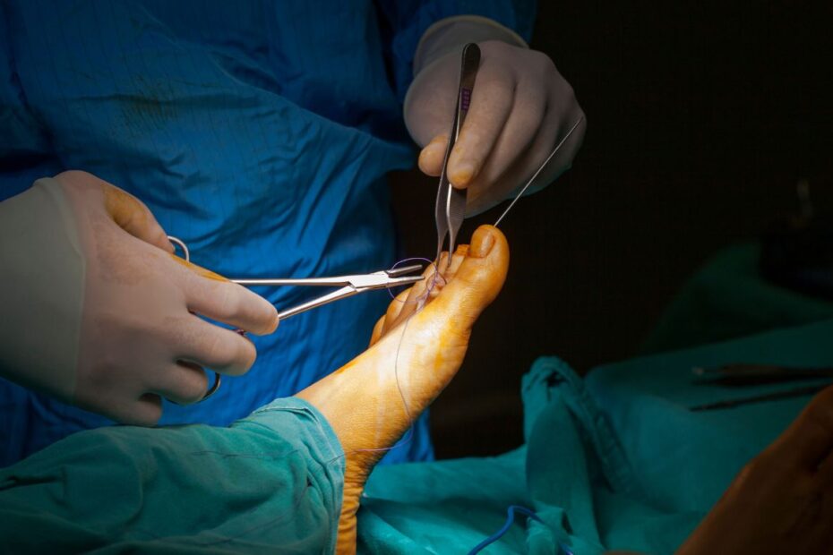 4 miesiące po operacji haluksa