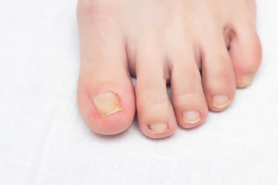 Plastry na wrastające paznokcie