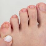 Bolący odcisk na małym palcu