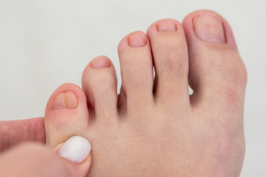 Bolący odcisk na małym palcu