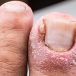 Usuwanie wrastającego paznokcia – kiedy to konieczne? Usuwanie wrastającego paznokcia